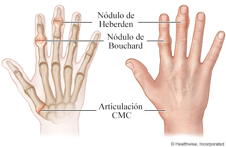 Nódulos de Heberden y de Bouchard y articulación CMC