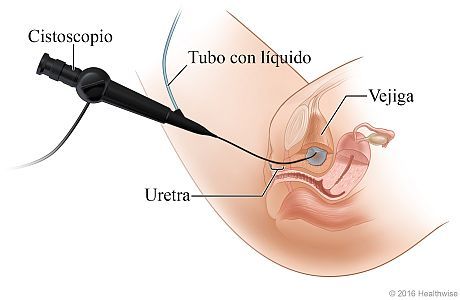 Imagen de cistoscopia de la vejiga.