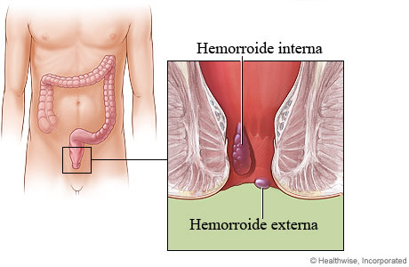 Imagen de hemorroides internas y externas