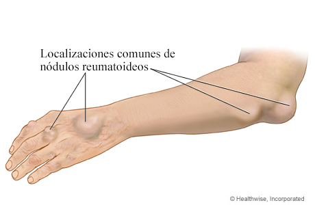 Imagen de los nódulos reumatoideos