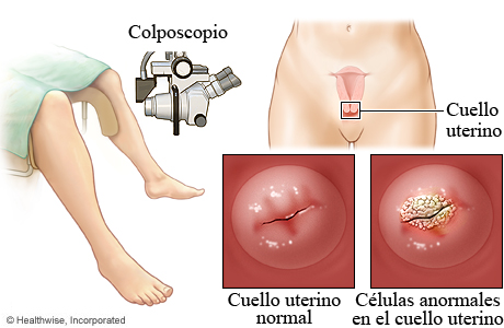 Colposcopio y el cuello uterino