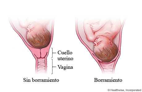 Borramiento del cuello uterino