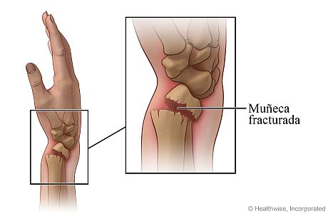 Vista ósea del antebrazo y de la mano, con detalle de la muñeca fracturada