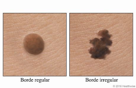 Un lunar normal y un lunar con un borde irregular y dentado