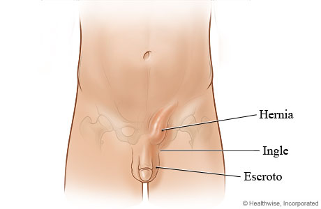 Hernia inguinal