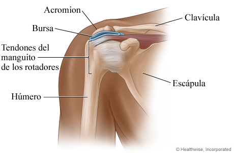 Bursitis del hombro