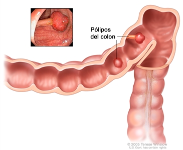 Pólipos del colon; se muestran dos pólipos (uno plano y otro pedunculado) en el interior del colon. En el recuadro se muestra una fotografía de un pólipo pedunculado.