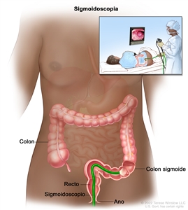 Sigmoidoscopia; muestra un sigmoidoscopio que se inserta a través del ano y el recto hacia el colon sigmoide. El recuadro interior muestra la imagen de un paciente en camilla al que se le realiza una sigmoidoscopía.