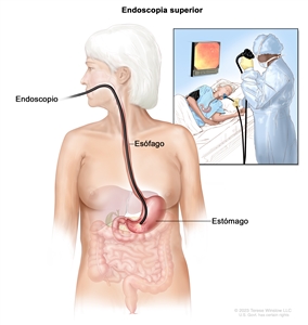 Endoscopia superior. En la imagen se observa un endoscopio (tubo delgado con una luz) que se introduce por la boca y la garganta hasta llegar al esófago y el estómago. El recuadro muestra una paciente acostada en una camilla mientras se le hace una endoscopia superior.