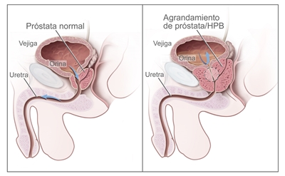 Un dibujo en dos paneles muestra la anatomía reproductora y urinaria normal así como hiperplasia prostática benigna (HPB). El panel de la izquierda muestra la próstata normal y el flujo de orina de la vejiga a la uretra. El panel de la derecha muestra un agrandamiento de próstata que ejerce presión sobre la vejiga y la uretra, con la obstrucción del flujo de la orina.