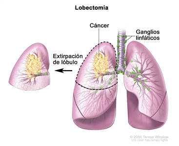 Lobectomía. En el dibujo se observan los pulmones izquierdo y derecho, la tráquea, los bronquios, los bronquiolos y los ganglios linfáticos. En el lóbulo superior del pulmón derecho se señala con una línea punteada el área con cáncer que se extirpará.