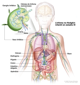 Linfoma no Hodgkin infantil en estadio III. En la imagen se observa cáncer en grupos de ganglios linfáticos por encima y debajo del diafragma, en el tórax, y en varias partes del abdomen, como en el hígado, el bazo, el intestino delgado y el apéndice. También se muestra el colon. En una ampliación se observa un ganglio linfático, una arteria y una vena. En el ganglio linfático hay células de linfoma (cancerosas).