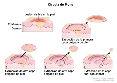 Cirugía de Mohs; el dibujo muestra una lesión visible en la piel. La imagen en detalle muestra un trozo de piel con cáncer en la epidermis (capa exterior de la piel) y la dermis (capa interna de la piel). Se observa una lesión visible en la superficie de la piel. Los cuatro cuadros numerados muestran la extracción de capas delgadas de piel una por una hasta que se termina de extraer todo el cáncer.