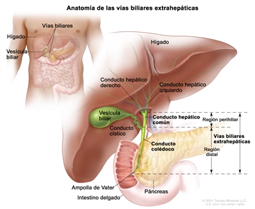 Anatomía de las vías biliares extrahepáticas. En el dibujo se señalan las vías biliares extrahepáticas, que abarcan el conducto hepático común, en la región perihiliar, y el conducto colédoco en la región distal. También se muestran el hígado, los conductos hepáticos izquierdo y derecho, la vesícula biliar, el conducto cístico, el páncreas, la ampolla de Vater y una parte del intestino delgado. En la parte superior izquierda del dibujo se observa el tronco de una persona adulta y se señala la ubicación del hígado, la vesícula biliar y las vías biliares dentro del cuerpo.