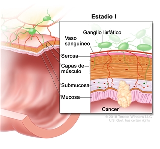 Cáncer colorrectal en estadio I. En la imagen se observa un corte transversal del colon o el recto. En el recuadro se muestran las capas de la pared del colon o el recto, y cáncer en la mucosa y la submucosa. También se muestran las capas de músculo, la serosa, los vasos sanguíneos y los ganglios linfáticos.