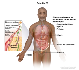 Cáncer de recto en estadio IV. En la imagen se muestran otras partes del cuerpo adonde es posible que el cáncer de recto se disemine, como los ganglios linfáticos lejanos, el pulmón, el hígado, la pared del abdomen y la próstata. En el recuadro se muestran las células cancerosas que se diseminan desde el recto, a través de la sangre y el sistema linfático, hasta otra parte del cuerpo donde se formó el cáncer metastásico.