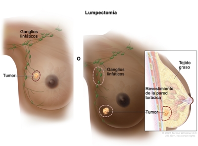 Lumpectomía. En el dibujo se observan las mamas (senos) de una mujer. En la mama de la izquierda se señala con una línea punteada el tumor que se extirpará y una parte de tejido normal que lo rodea. En la mama de la derecha se señalan con líneas punteadas las áreas que se extirparán: algunos ganglios linfáticos de la axila, el tumor y parte del revestimiento de la pared torácica cerca del tumor. También se observa una ampliación de la vista lateral de la mama donde se muestra el tejido graso mamario.