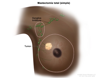 Mastectomía total (simple). En el dibujo se señalan con líneas punteadas las zonas que se extirparán: la mama completa que incluye un tumor y algunos de los ganglios linfáticos de la axila.