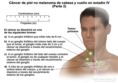 Cáncer de piel no melanoma de cabeza y cuello en estadio IV (Parte 2). En el dibujo se observa un tumor primario en la cara y cáncer que se diseminó en una de las siguientes formas: a) a un ganglio linfático que mide más de 6 cm; b) a un ganglio linfático del mismo lado del cuerpo que el tumor, el ganglio mide más de 3 cm y el cáncer se diseminó a través del recubrimiento externo del ganglio; c) a un ganglio linfático del lado del cuerpo contrario al tumor, el ganglio es de cualquier tamaño y el cáncer se diseminó a través del recubrimiento externo del ganglio; y d) a más de un ganglio linfático de uno o ambos lados del cuerpo, y el cáncer se diseminó a través del recubrimiento externo de los ganglios. También se observan una regla de 10 cm y una regla de 4 in.