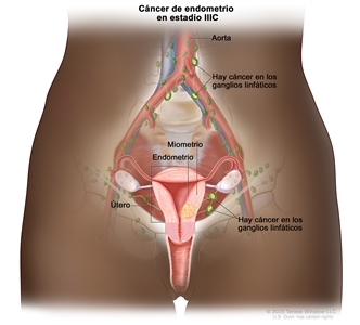 Cáncer de endometrio en estadio IIIC. En el dibujo se muestra cáncer en el endometrio y el miometrio del útero. También se observa cáncer en los ganglios linfáticos de la pelvis y en los que están cerca de la aorta.