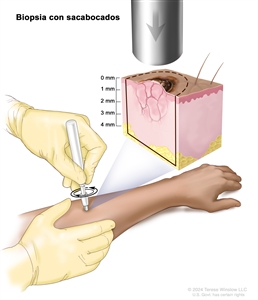 Biopsia con sacabocados. En el dibujo se observa un instrumento con forma de lápiz que en un extremo tiene un bisturí cilíndrico hueco que se coloca sobre una lesión de la piel del antebrazo del paciente y se hace girar en el sentido de las agujas del reloj y en el sentido contrario para cortar la piel y extraer una muestra pequeña de tejido con forma de cilindro. En una ampliación se observa el bisturí cilíndrico y se señala el lugar donde corta la piel y la profundidad hasta donde llega, de alrededor de 4 milímetros (mm) en la capa del tejido graso debajo de la piel.