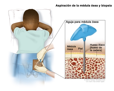 Aspiración de la médula ósea y biopsia; el dibujo muestra a un niño acostado boca abajo en una camilla y una aguja para la médula ósea que se inserta en el hueso ilíaco (hueso de la cadera) derecho. El recuadro muestra la aguja para la médula ósea que se inserta a través de la piel hasta la médula ósea del hueso de la cadera.