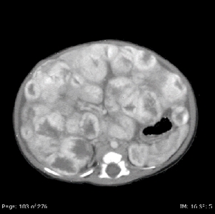 Imagen por TC de lesiones hepáticas difusas.