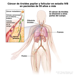 Cáncer de tiroides papilar y folicular en estadio IVB en pacientes de 55 años o más. En la imagen se muestran otras partes del cuerpo donde es posible que el cáncer de tiroides se disemine, como los pulmones y los huesos. En el recuadro se muestran las células cancerosas que se diseminan desde la tiroides, a través del sistema sanguíneo y linfático, hasta otra parte del cuerpo donde se formó el cáncer metastásico.