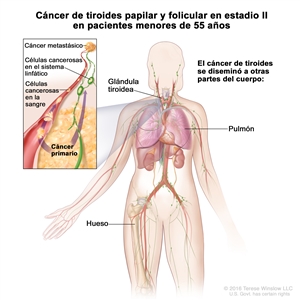 Cáncer de tiroides papilar y folicular en estadio II en pacientes menores de 55 años. En la imagen se muestran otras partes del cuerpo donde es posible que el cáncer de tiroides se disemine, como los pulmones y los huesos. En el recuadro se muestran las células cancerosas que se diseminan desde la glándula tiroidea, a través del sistema linfático, hasta otra parte del cuerpo donde se formó el cáncer metastásico.