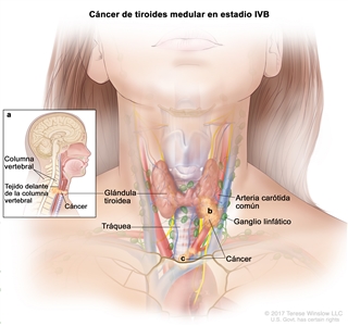 Cáncer de tiroides medular en estadio IVB. En la imagen se muestra que el cáncer a) se diseminó desde la glándula tiroidea hasta el tejido delante de la columna vertebral y hasta la columna vertebral, b) rodeó la arteria carótida común y c) rodeó los vasos sanguíneos del área entre los pulmones. También se muestran los ganglios linfáticos y la tráquea.