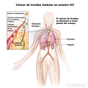 Cáncer de tiroides medular en estadio IVC. En la imagen se muestran otras partes del cuerpo donde es posible que el cáncer de tiroides se disemine, como el pulmón y el hígado. En el recuadro se muestran células cancerosas que se diseminan desde la tiroides, a través del sistema sanguíneo y linfático, hasta otra parte del cuerpo donde se formó el cáncer metastásico.