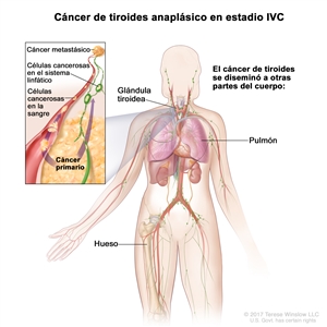 Cáncer de tiroides anaplásico en estadio IVC. En la imagen se muestran otras partes del cuerpo donde es posible que el cáncer de tiroides se disemine, como los pulmones y los huesos. En el recuadro se muestran las células cancerosas que se diseminan desde la glándula tiroidea, a través del sistema sanguíneo y linfático, hasta otra parte del cuerpo en donde se formó el cáncer metastásico.