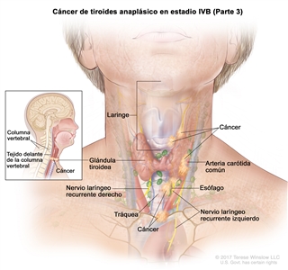 Cáncer de tiroides anaplásico en estadio IVB (Parte 3). En la imagen se muestra el cáncer que se diseminó desde la glándula tiroidea hasta el esófago, la tráquea, la laringe, el nervio laríngeo recurrente izquierdo y el tejido delante de la columna vertebral (recuadro). El cáncer también rodeó la arteria carótida común y los vasos sanguíneos del área entre los pulmones. También se muestra el nervio laríngeo recurrente derecho.