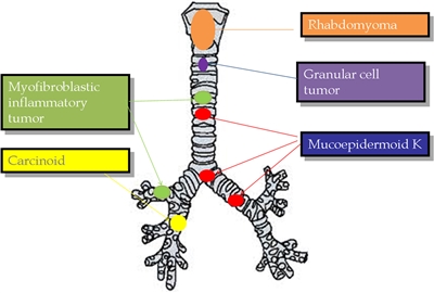 En la imagen se observan los tumores traqueobronquiales primarios más representativos en los niños: tumor miofibroblástico inflamatorio, tumor carcinoide, rabdomioma, tumor de células granulosas y carcinoma mucoepidermoide K.