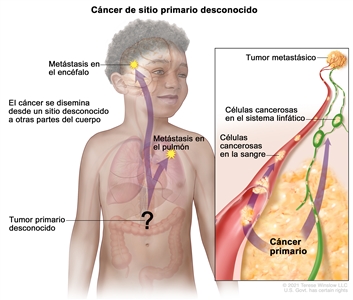 Cáncer de sitio primario desconocido. Dibujo de un niño donde se señala un área en el abdomen que indica la presencia de un tumor primario que se diseminó desde un sitio desconocido a otras partes del cuerpo, como el pulmón (metástasis en el pulmón o pulmonar) o el encéfalo (metástasis en el encéfalo, encefálica o cerebral). En un recuadro, se observan las células cancerosas que se diseminan desde el cáncer primario, a través de los sistemas sanguíneo y linfático, a otra parte del cuerpo dónde se formó un tumor metastásico.