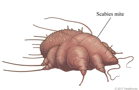 Scabies mite.