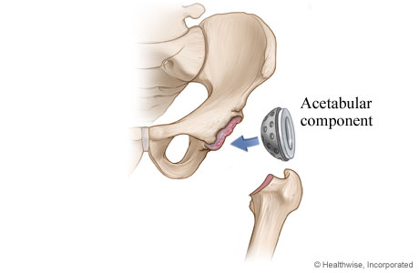 Hip replacement: Hip socket component is placed