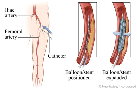 Balloon and stent positioned and expanded.