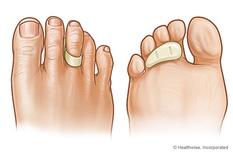 Toe crest pad as it appears on top of and under a toe