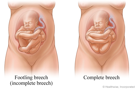 Footling (incomlete) and complete breech positions