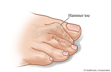 Hammer toe