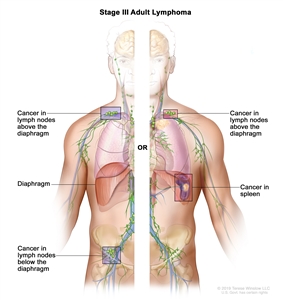 Stage III adult lymphoma; drawing shows the right and left sides of the body. The right side of the body shows cancer in a group of lymph nodes above the diaphragm and below the diaphragm. The left side of the body shows cancer in a group of lymph nodes above the diaphragm and cancer in the spleen.