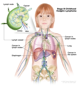 Stage III childhood Hodgkin lymphoma; drawing shows (a) cancer in lymph node groups above and below the diaphragm. Also shown is (b) cancer in a lymph node group above the diaphragm and cancer in the spleen. The lungs are also shown. An inset shows a close-up of a lymph node with a lymph vessel, an artery, and a vein. Cancer cells are shown inside the lymph node.