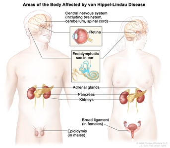 Drawing of a male figure and female figure showing areas of the body affected by von Hippel-Lindau disease. These areas include the central nervous system (including the brainstem, cerebellum, and spinal cord), retina, endolymphatic sac in the ear, adrenal glands, pancreas, kidneys, epididymis (in males), and broad ligament (in females).