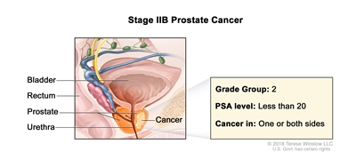 Stage IIB prostate cancer; drawing shows cancer in one side of the prostate. The PSA level is less than 20 and the Grade Group is 2. Also shown are the bladder, rectum, and urethra.