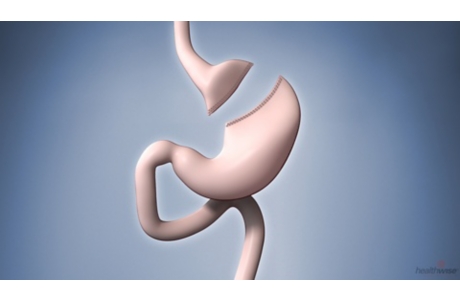 Roux-En-Y Gastric Bypass