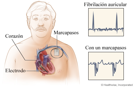 Ubicación del marcapasos en el pecho, con detalle de los resultados de los electrocardiogramas antes y después de su colocación Ubicación del marcapasos en el pecho, con detalle de los resultados de los electrocardiogramas antes y después de su colocación