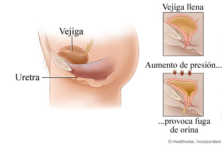 Incontinencia urinaria por esfuerzo en mujeres