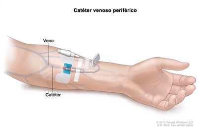 Catéter venoso periférico. En el dibujo del antebrazo de una persona, se señala la punta de un catéter venoso periférico dentro de una vena, el catéter se conecta con un tubo (sonda) exterior mediante un sistema de fijación sobre la piel. El tubo está pinzado y en el extremo tiene una tapa.