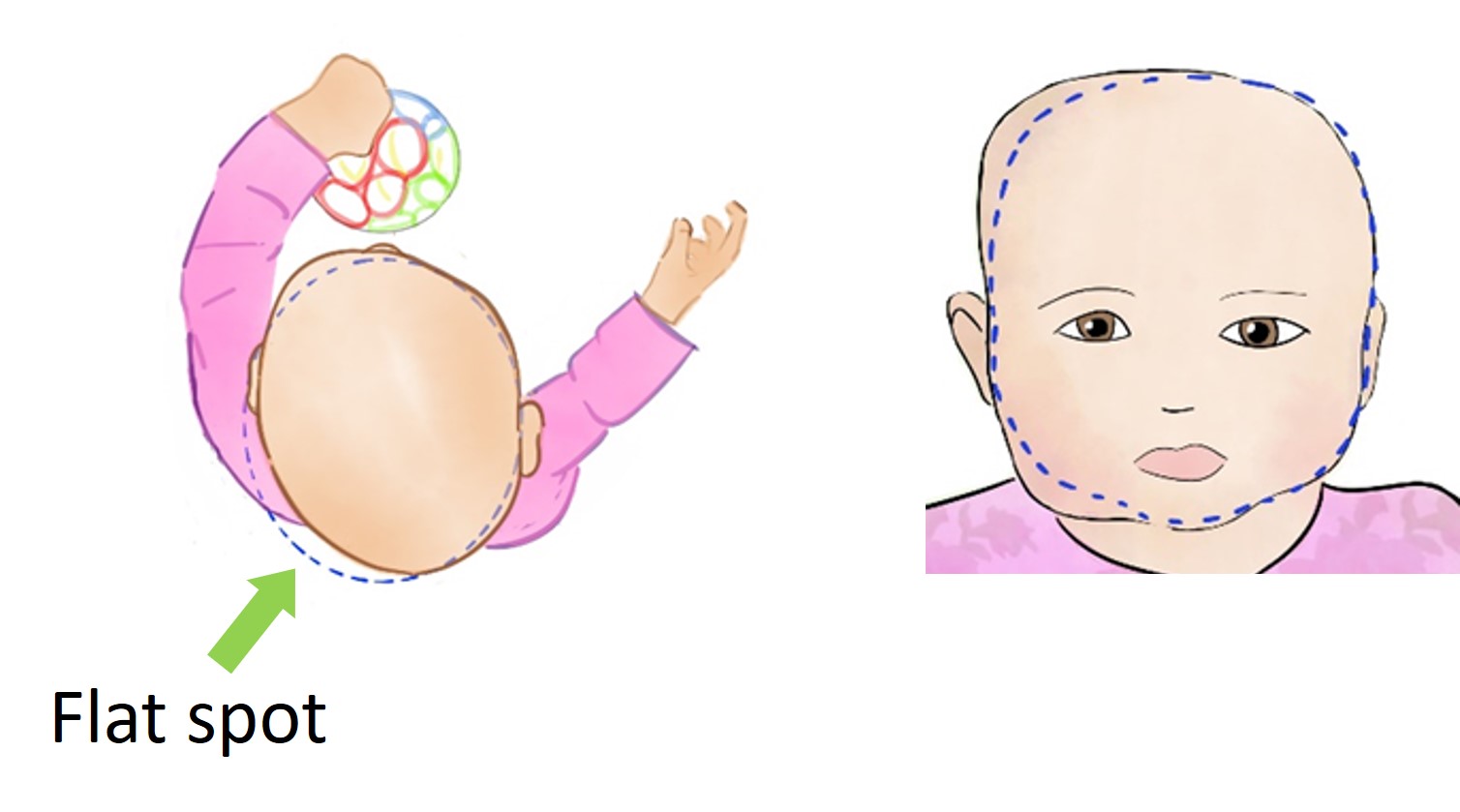 baby with flat spot